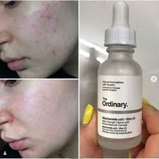 The Ordinary Niacinamide 10% + Zinc 1 % β 30ml |oil Control, Pore Minimizing & Blemish Solution Serum